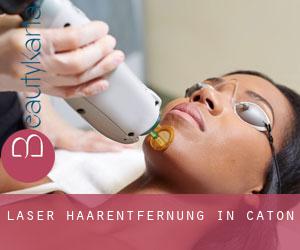 Laser-Haarentfernung in Caton