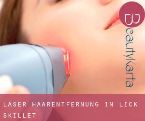 Laser-Haarentfernung in Lick Skillet