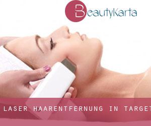 Laser-Haarentfernung in Target