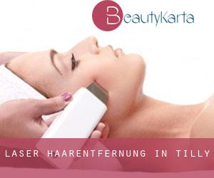 Laser-Haarentfernung in Tilly